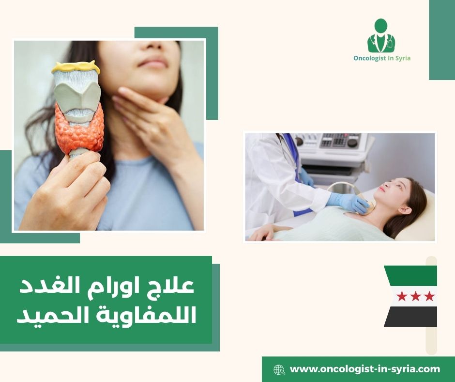 علاج اورام الغدد اللمفاوية الحميد