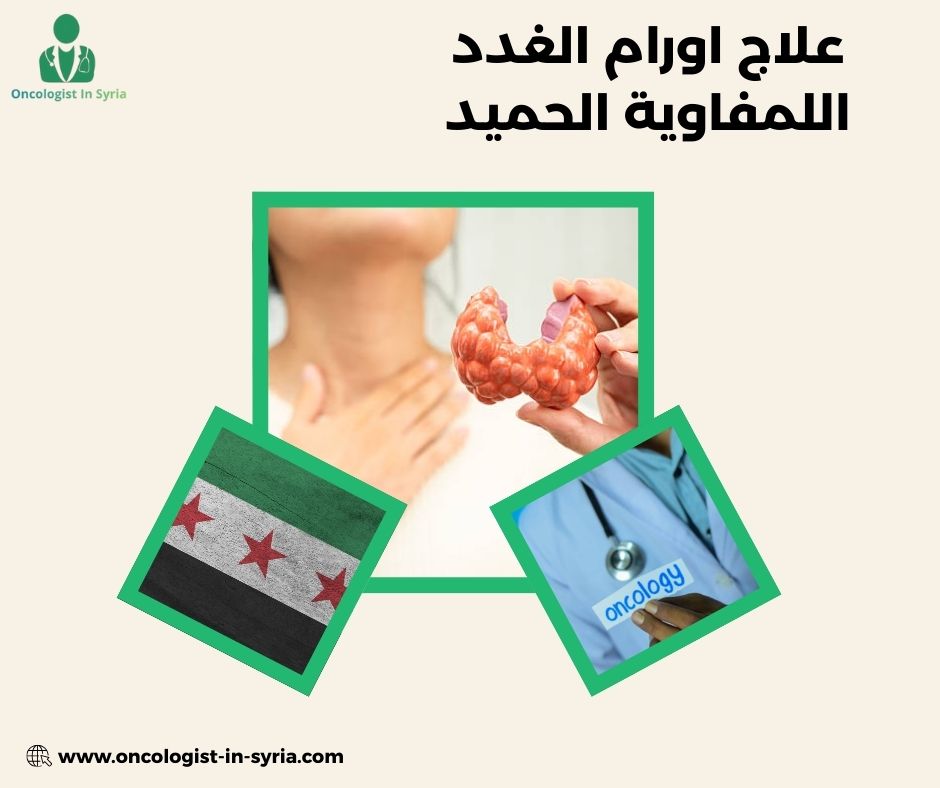 علاج اورام الغدد اللمفاوية الحميد