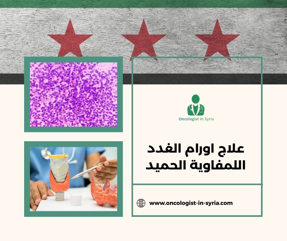 علاج أورام الغدد اللمفاوية