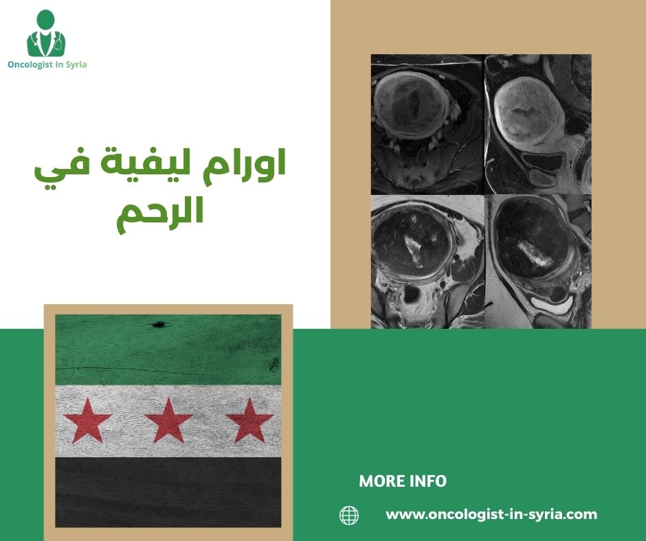 اورام ليفية في الرحم